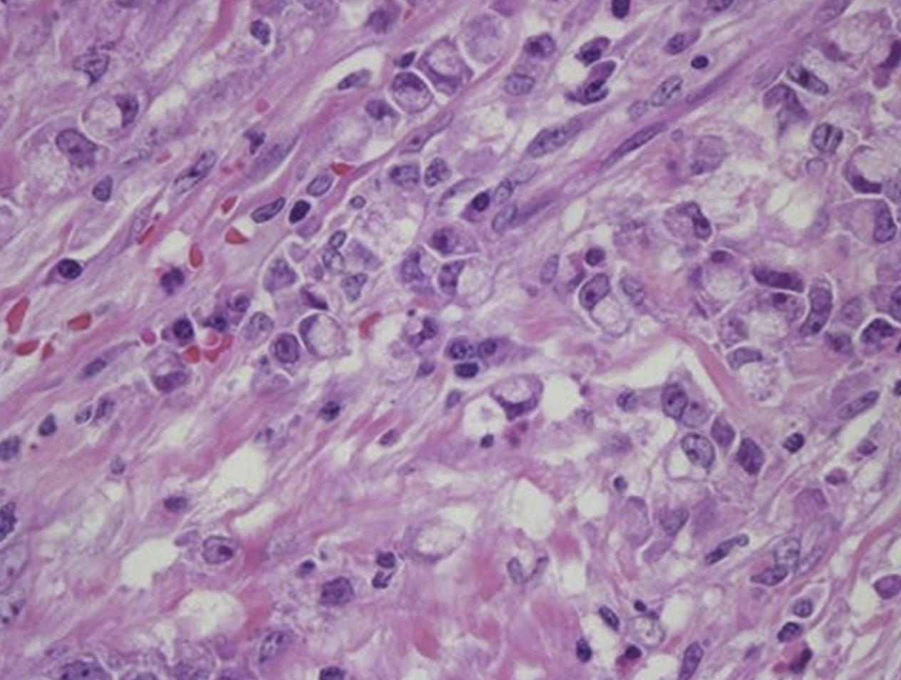 Gastric signet ring cell carcinoma in a 59-year old male patient.