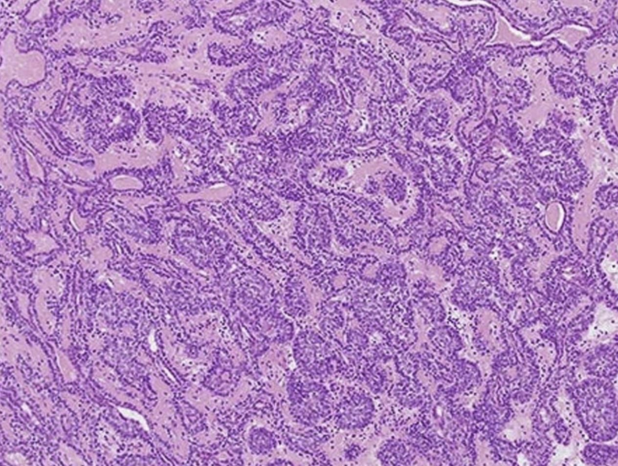 Spiradenoma presenting as a dermal nodule in chest of a 55-year old female patient.