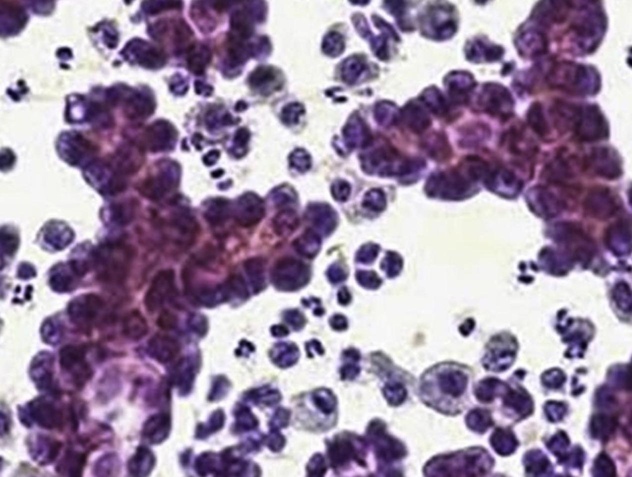 Papillary thyroid carcinoma in a 34-year old female patient.
