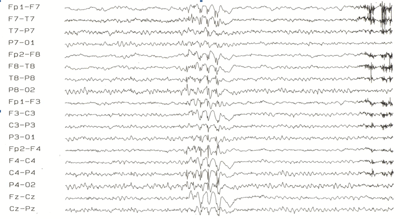 An EEG (for electrical function)