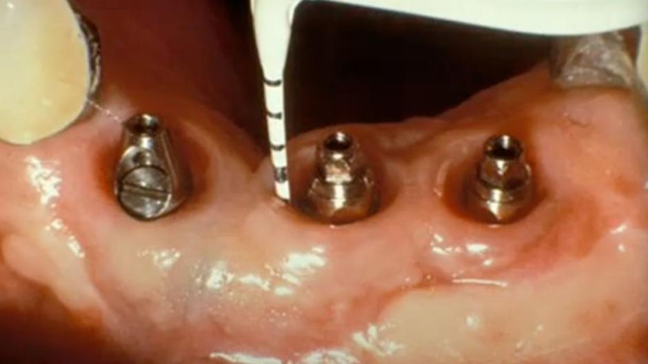 Photo of implant screws in person's mouth