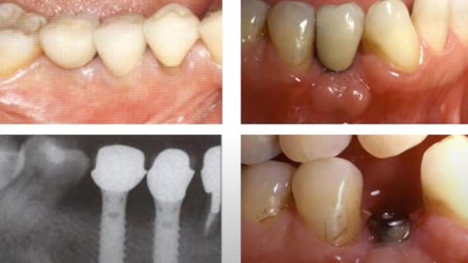 Photos of teeth and x-rays with prosthetics