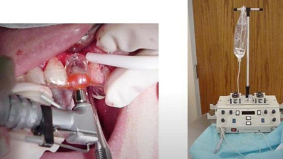Photos of implant surgery and medical device.