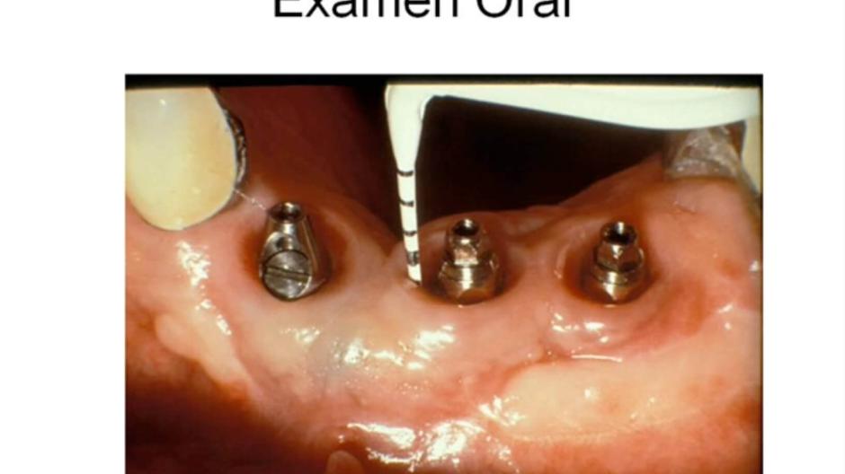 Video thumbnail featuring a row of dental implants set in gums