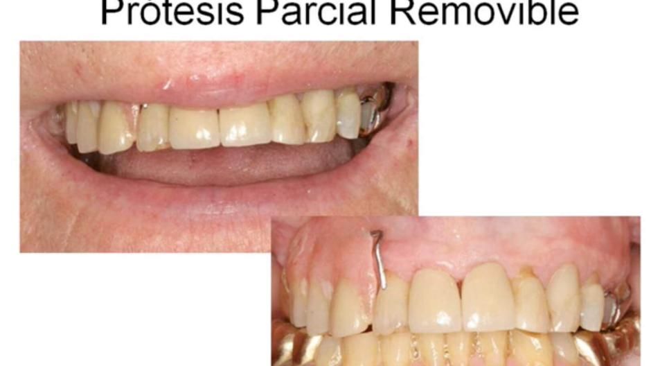 Video thumbnail featuring partial removable dentures