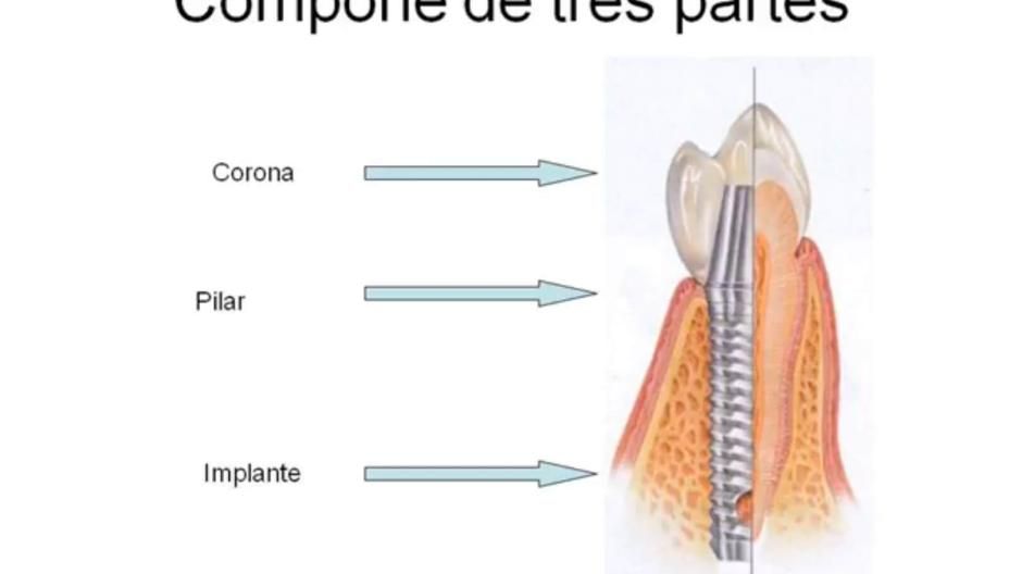 Video thumbnail featuring the different parts of a dental implant