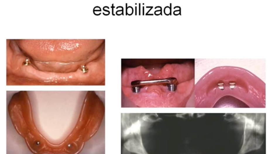 Video thumbnail showing different types of dental implants